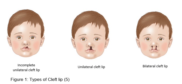 Cleft Lip And Palate In Neonates | Safer Care Victoria